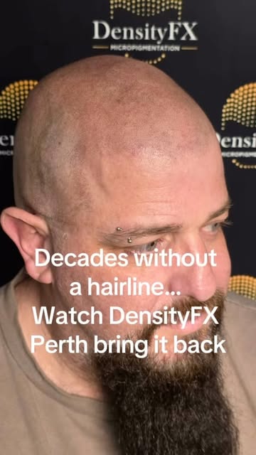 Decades without a hairline… watch it be created. 🔥

2 sessions in. A new hairline taking shape.

Af