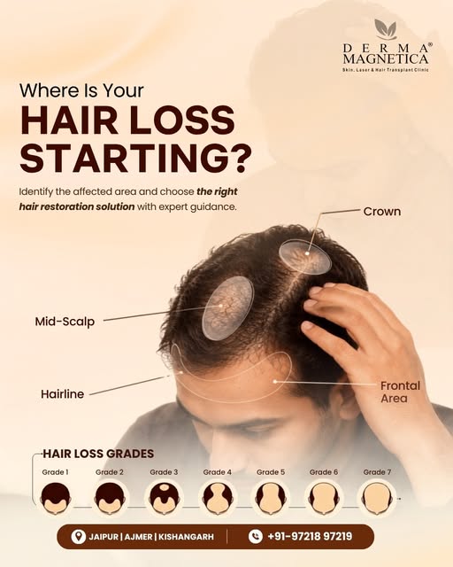 Where is your hair loss starting? 🧑‍🦱🔍

Hair loss can begin at different areas — from the hairlin