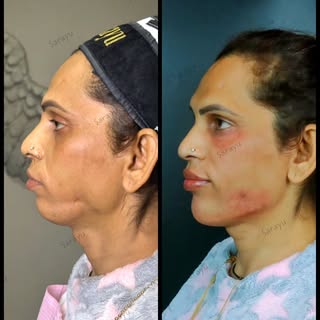 Non-Surgical Full Face Sculpting at Sarayu Clinics by Dr. Adarsh Tripathi’s advanced techniques make