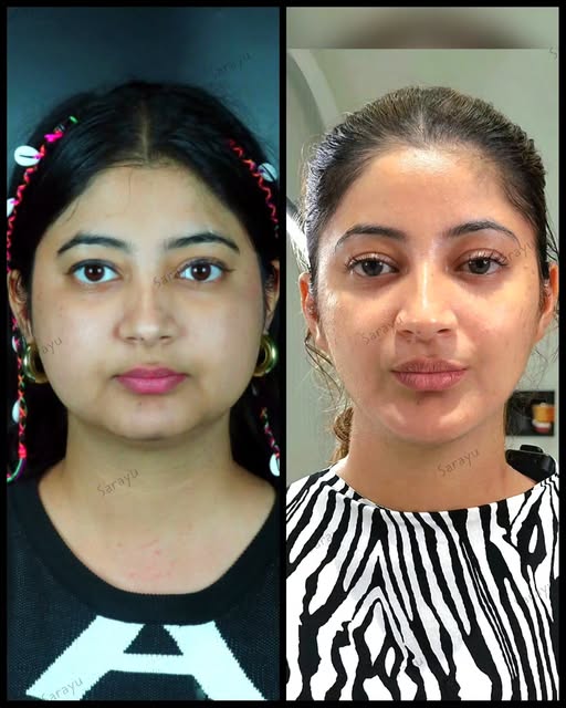 CHIN IMPLANT & BUCCAL FAT REMOVAL (Permanent Chin Enhancement & Permanent Mid Face Slimming) & LIP E