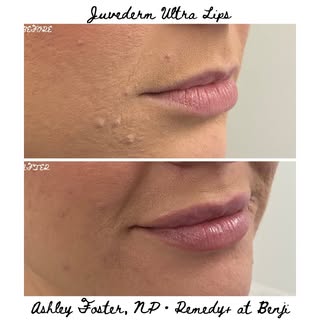 👄lips: if the patient wants bigger volume and has the tissue for it, Juvederm Ultra is a flippin’ O