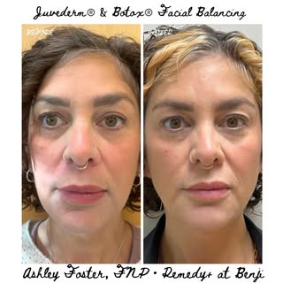 👩🏻‍🦱Pics 1&4: temples, cheeks, jawline as the foundation for her main wishes: lips and nasolabial