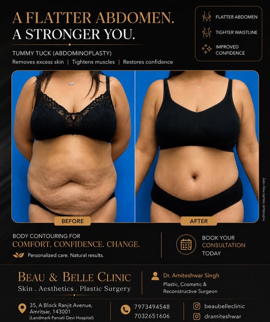 TUMMY TUCK | BEFORE → AFTER

A flatter, firmer abdomen with removal of excess skin and improved abdo