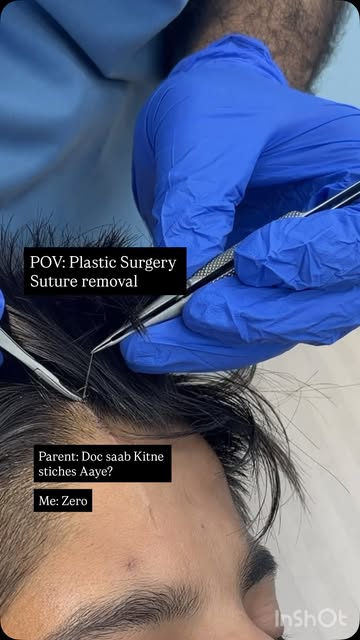 “Doctor, stitches kaise remove hote hain?” 👀

Subcuticular suture —
skin ke andar buried hota hai.
