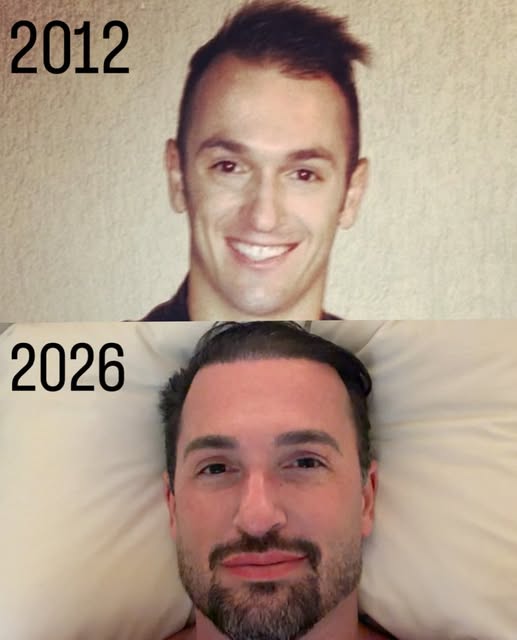 São quatorze anos de diferença e de vários tratamentos! Tudo iniciei com meu amigo @drzei 
Sempre se