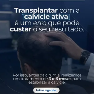 O sucesso de um transplante capilar vai muito além do dia da cirurgia.

O sucesso do tratamento come
