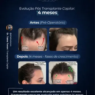 ✔️ ANÁLISE CLÍNICA:

Aos 4 meses, observamos uma evolução excelente e natural. A nova hairline foi m