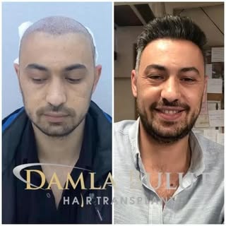 Before&After 👌💯

Call us to get the hair of your dreams. 💫

📞 +905446132686 

.

.

.

#hair #ha