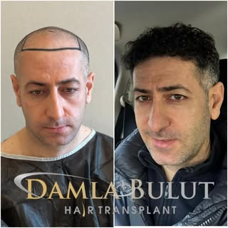 Before&After 👌💯

Call us to get the hair of your dreams. 💫

📞 +905446132686 

.

.

.

#hairtran