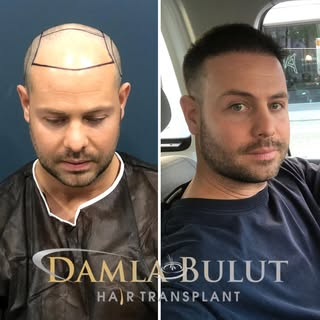 Before&After 👌💯

Call us to get the hair of your dreams. 💫

📞 +905446132686 

.

.

.

#hair #ha