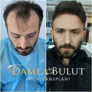 🔹 Saçlarınızı Kök Hücre Teknolojisi ile Yenilemeye Hazır mısınız?

✅ Özel Losyon ve Şampuan 
✅ Tüm 