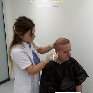 #hairtransplant #saçekimi #safirsaçekimi #reels