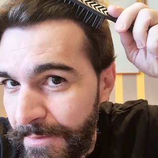 Resultado incrível de 06 meses de um paciente muito querido 🫶 Hairline natural e com alta densidade