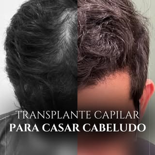Ele marcou o transplante capilar com um objetivo bem claro: chegar no dia do casamento cabeludo. 

U