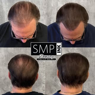 Some of our clients have had multiple hair transplants and just a little natural density is what is 