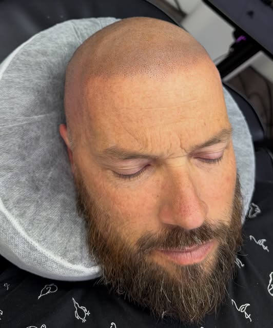 This client had work done in the past by another artist, but wasn’t in love with his hairline. He th