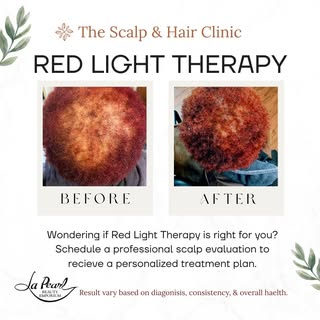 ✨ Can Red Light Therapy help with hair loss?

Red Light Therapy is one of the treatments we use to s