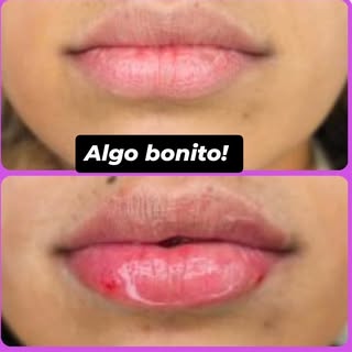 Lips booster! En 15 dias toca la segunda sesión. Les cuento como.vamos!