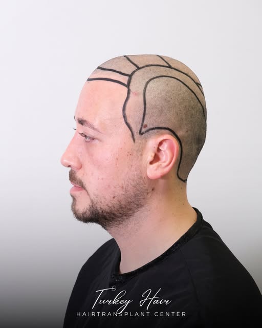 A clear plan is the first step toward a natural result.
Every hair transplant journey starts with de