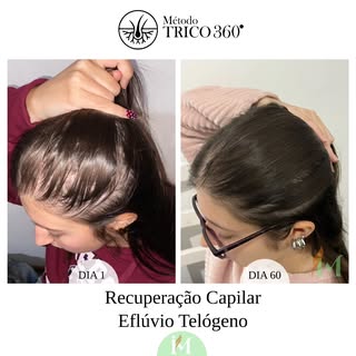 Depois de 60 dias cabelos novos nasceram e preencheram as linhas marcadas pelas falhas.

O tratament
