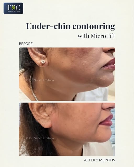 Under-chin and jawline contouring with MicroLift.

MicroLift uses a 1470 nm laser to generate deep t