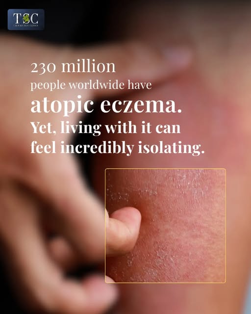 Atopic eczema is more than skin deep.

The visible symptoms are only part of the picture. Living wit