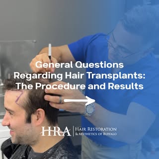 ✨ Thinking about a hair transplant but not sure what to expect? ✨

At HRA Buffalo, we’re here to ans