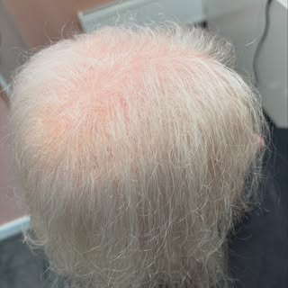 A beautiful transformation using a bespoke hair system, perfectly colour-matched in soft white tones