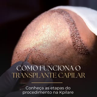 Entenda como acontece o transplante capilar na prática!

Na Kpilare, cada etapa é planejada com prec