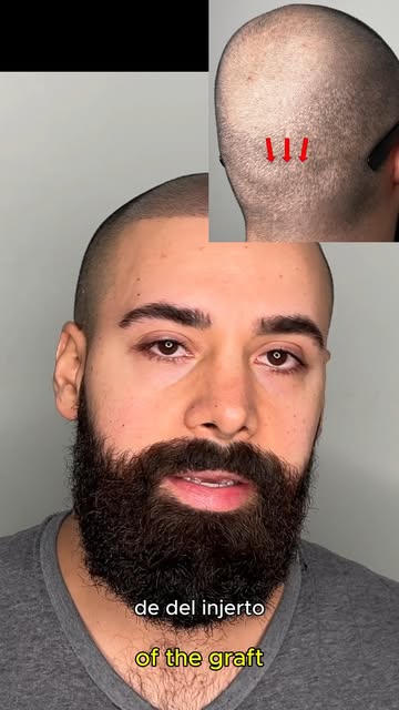 Finasteride, minoxidil es unos de los medicamentos que mas me comentan mis clientes que toman o se a