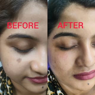 Laser Treatment Result