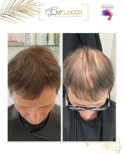 Tricopigmentation ou micro-pigmentation du cuir chevelu

La Micro-pigmentation est une technique inn