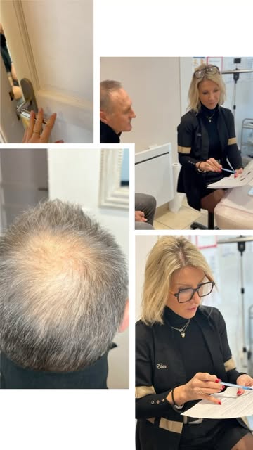 #tricopigmentation #consultation importante et déterminante pour choisir la technique et la faisabil