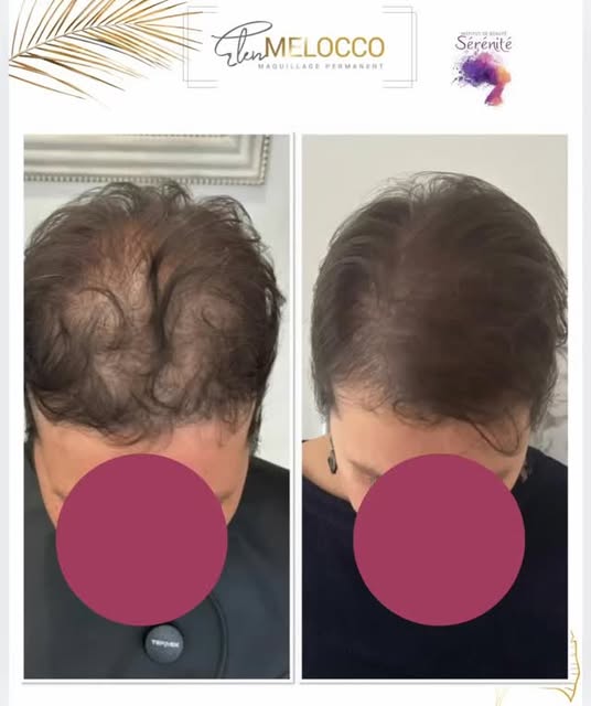 Perdre ses cheveux après une maladie, c’est aussi perdre un repère… parfois une part de soi.

La pig