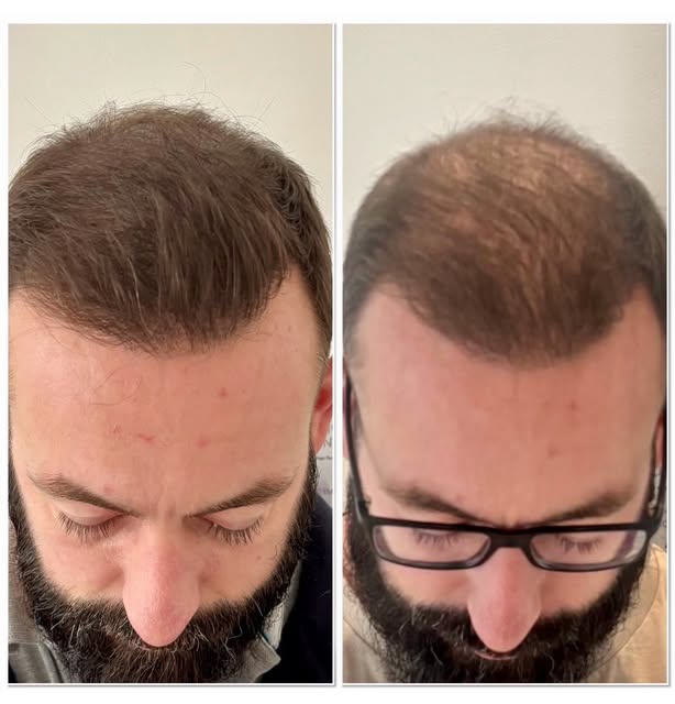 pigmentation capillaire – résultat après quelques mois ✨
Une densité retrouvée, un effet naturel, un