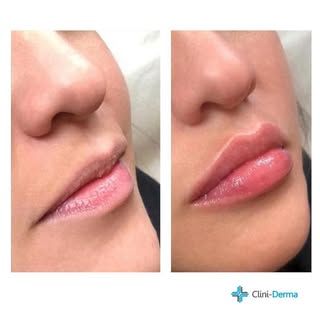 Augmentation naturelle de la lèvre supérieure pour des lèvres pulpeuses 💋⁠
•
Résultat - immédiat⁠
D