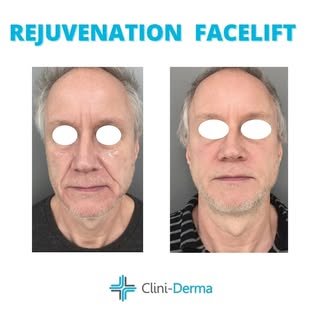 Beaucoup de patients, on recourt au facelift non chirurgical afin de réduire leurs rides et ridules 