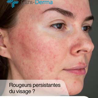 La rosacée est une affection cutanée chronique qui provoque des rougeurs persistantes, principalemen