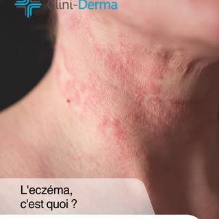 L'eczéma est une maladie inflammatoire de la peau qui se manifeste par des rougeurs, des démangeaiso
