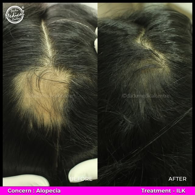 Alopecia can lead to noticeable hair thinning and visible patches on the scalp. 🧑‍⚕️✨ But with the 
