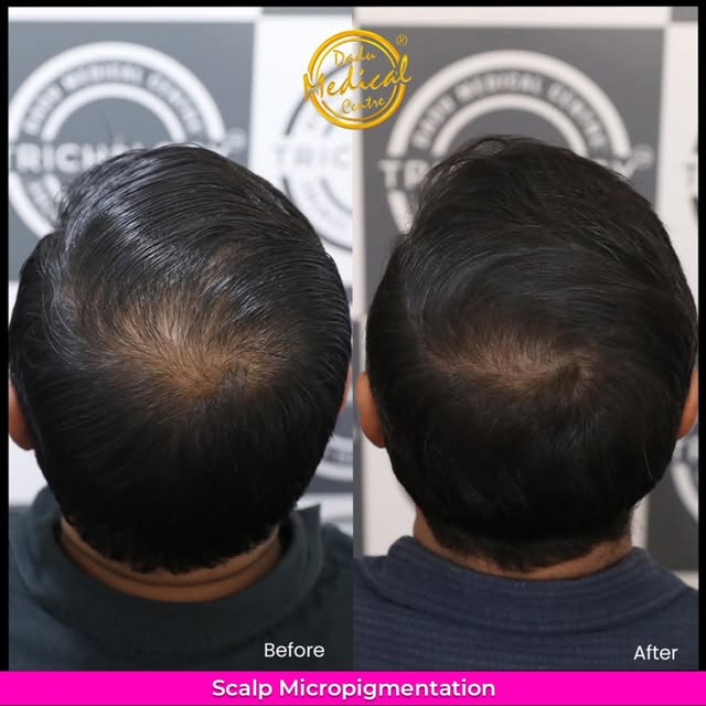 This Scalp Micropigmentation (SMP) transformation shows how carefully placed pigment can create the 