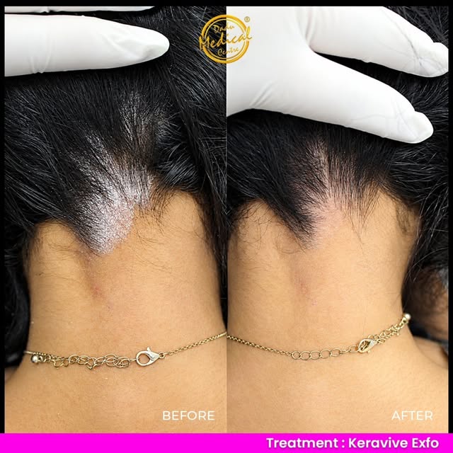 Healthy hair starts with a healthy scalp. ✨🧖‍♀️
This before & after shows visible improvement in sc