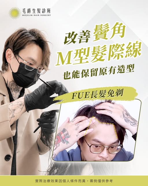 💈知名髮型設計師，也逃不過 #M型禿 困擾✂️
每天幫別人打造完美髮型，
卻為自己的髮際線後退而困擾😞
但他最大的顧慮是——「想植髮，卻不想剃髮」

選擇 #長髮免剃FUE植髮
✔ 保留原有長髮，