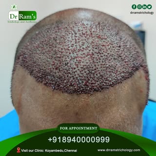 Dr Rams Trichology & Aesthetics
"Advance Hair Transplant Method with Unlimited Follicles, Immediatel