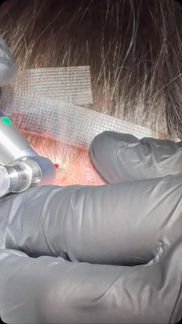 “This is the part I didn’t even realize was happening… it felt so precise and minimal.”

FUE hair ex