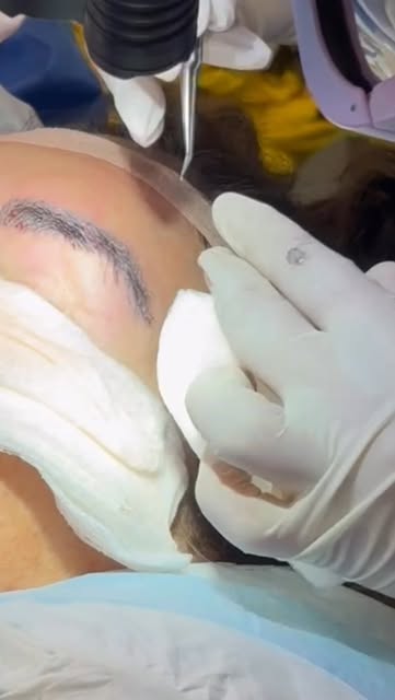 Eyebrow Transplant Day ✨

From sparse to sculpted in one session.

Today we designed, harvested, and