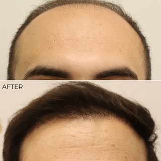Before ➡️ After

A thoughtfully designed hairline can completely restore balance and confidence.
Nat