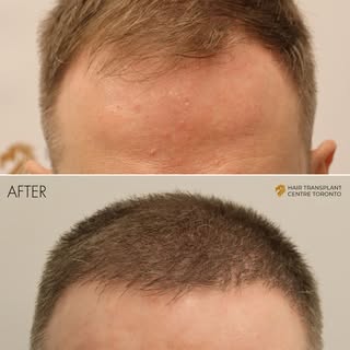 A natural hair transplant isn’t about lowering the hairline dramatically -it’s about respecting faci