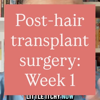 The first week after my hair transplant surgery at @torontohairtransplantcentre