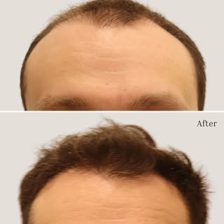 This patient came to us with significant hairline recession and left with a result that speaks for i